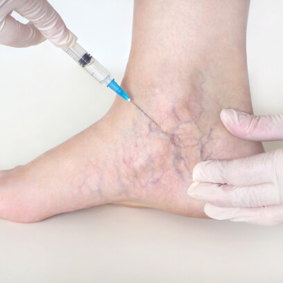 Needle injection into an ankle with veins.
