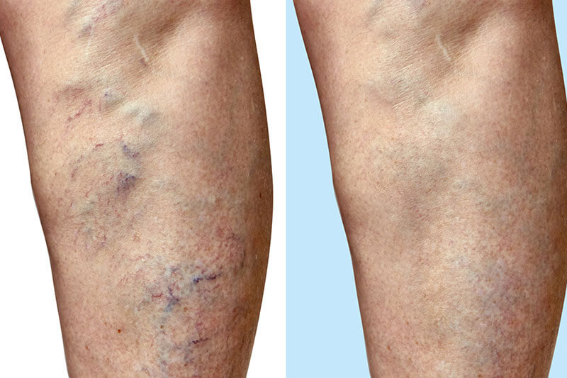 Before and after varicose vein treatment