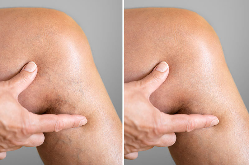 Before and after varicose vein treatment