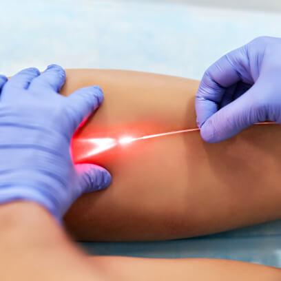Laser treatment for veins in the leg - vein doctor in Michigan