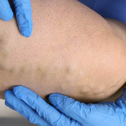 Veins in the leg - vein doctor in Michigan