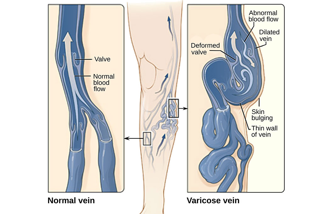 Varicose veins on the legs diagram.