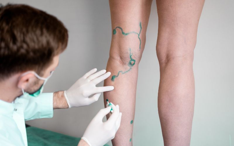 mapping out vein treatment - Michigan vein specialist
