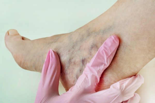 vein problems in the foot